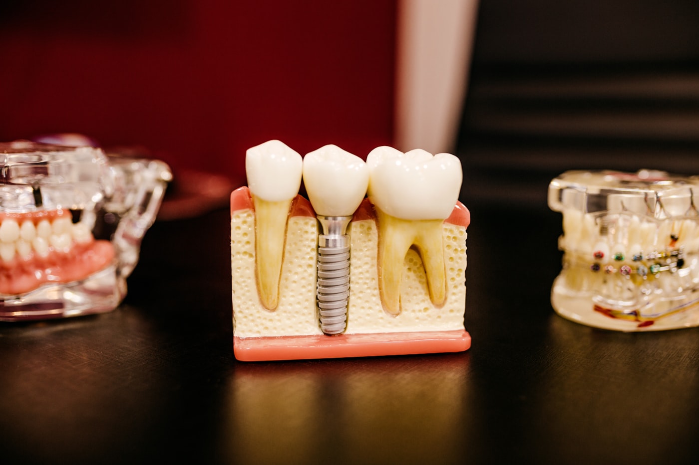 Dental implant and crown model on a desk